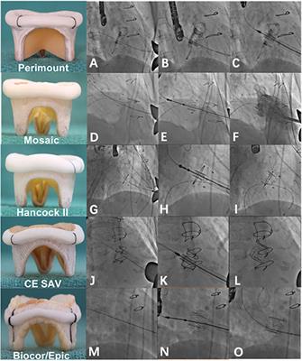 Transcatheter Mitral Valve-in-Valve Implantations Using Inverted J-Valve